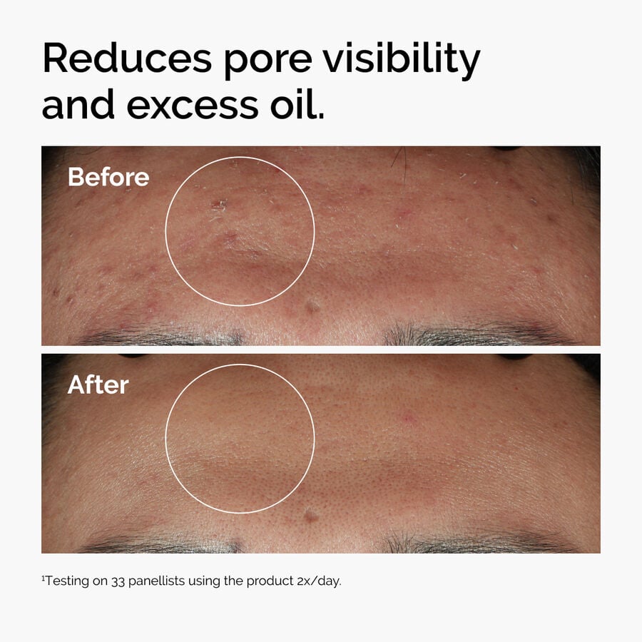 niacinamide-10-zinc-1-r1 ord-niacinamide-zinc-blemish-serum-before-after-pores.jpg